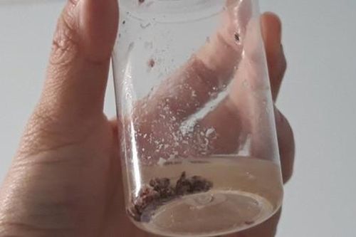 Đau, nhức đầu nhiều năm do vật liệu trám răng lọt vào xoang hàm