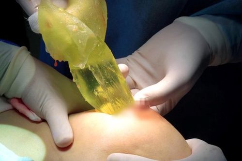 Nâng cấp vòng một ở cơ sở thẩm mỹ 'chui', quý bà 'vỡ toang' ngực
