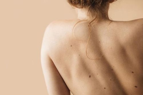 Làm tốt 4 điều này, bạn sẽ không phải lo về đốm đồi mồi xuất hiện trên da