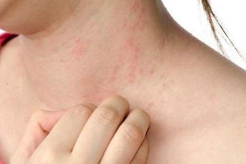 Các bệnh ngoài da thường gặp