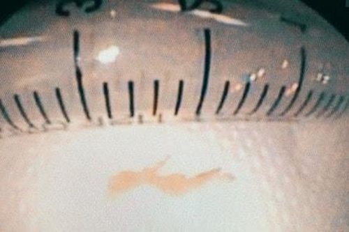 Phẫu thuật lấy xương cá găm vào thành ruột bé trai 3 tuổi