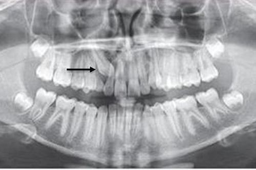 Những dấu hiệu gợi ý răng ngầm và điều trị