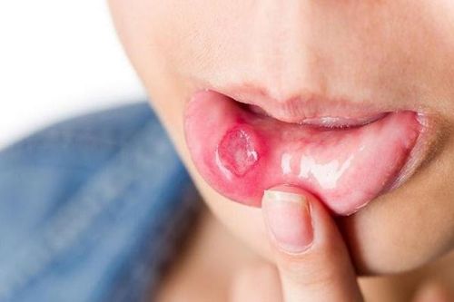 Những điều cần biết về cách chữa trị nhiệt miệng