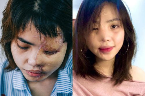 Cô gái bị tạt axit dần hồi phục sau gần 2 năm