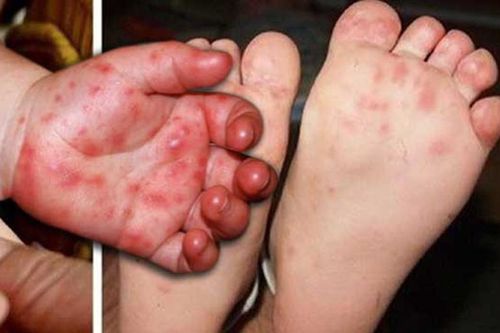 Thiếu thuốc điều trị bệnh tay chân miệng là thông tin không chính xác