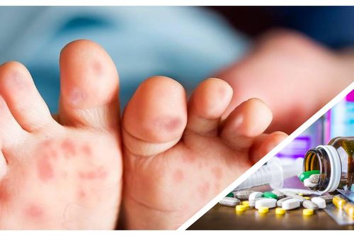 Có hay không việc thiếu thuốc điều trị tay chân miệng?