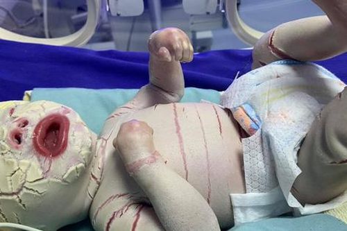 Xót xa hình ảnh bé sinh non da bị lớp sừng bao phủ, nứt toác