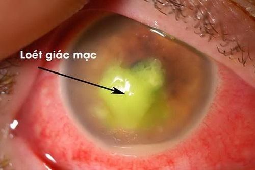 Viêm loét giác mạc nhiễm khuẩn: Nguy cơ cao gây mù lòa