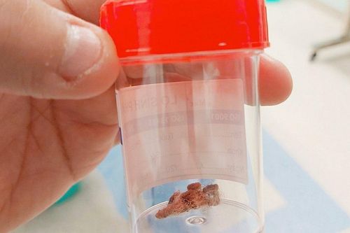Miếng bông gòn kẹt trong âm đạo bé gái
