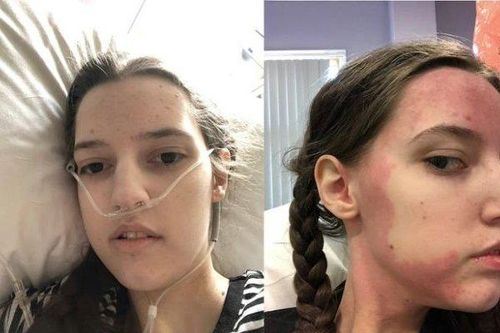 Cô gái mắc bệnh lạ, dị ứng tất cả đồ ăn trên thế giới