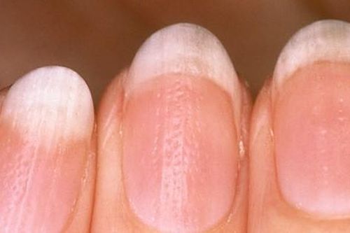 9 dấu hiệu cảnh báo bệnh tật trên móng tay: Dấu hiệu bệnh về gan rất dễ nhận biết