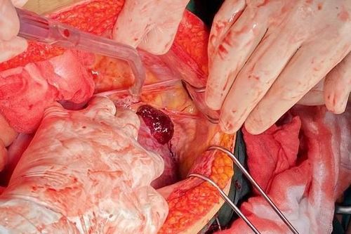 Hà Nội: 'Báo động đỏ' toàn viện cứu sống thần kỳ sản phụ vỡ thai, chảy máu ồ ạt