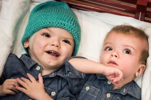 Sau tách rời, các cặp song sinh dính liền được chăm sóc như thế nào?