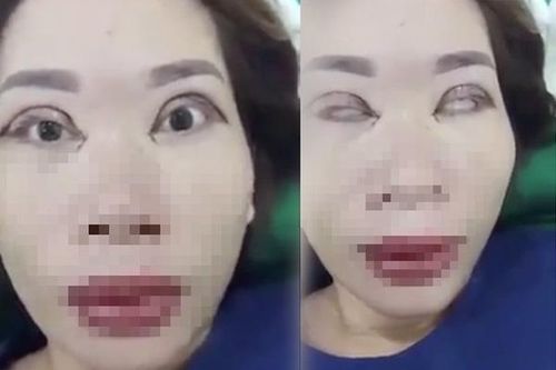 Bỏ tiền đi cắt mí, người phụ nữ nhận cái kết là đôi mắt không thể nhắm