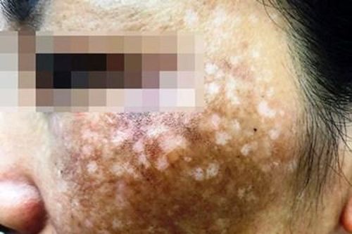 Chữa rám má hết 500 triệu đồng, người phụ nữ 'cầu cứu' bác sĩ