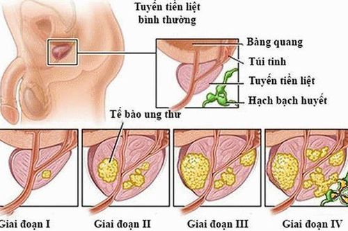 Ung thư tuyến tiền liệt không còn đáng sợ