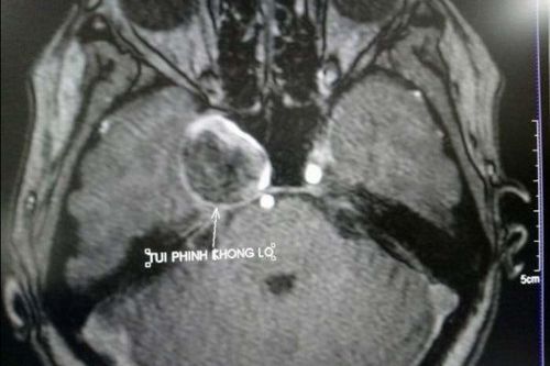 Vô hiệu hóa túi phình động mạch não khổng lồ mà không cần phẫu thuật
