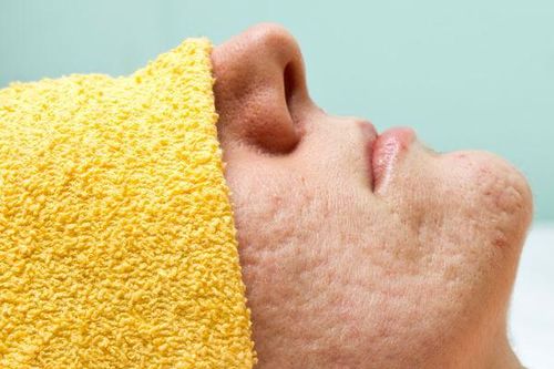 5 nguyên nhân khiến bạn bị lỗ chân lông to