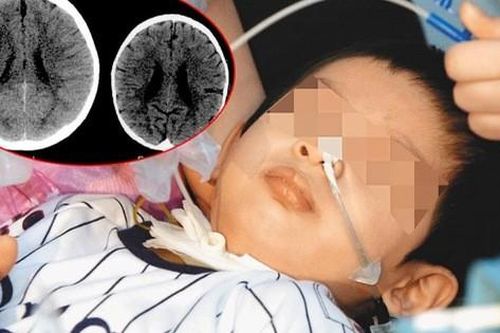 Cậu bé 3 tuổi bị teo não như cụ ông 80, vừa lật áo khám bác sĩ đã giật mình và sự thật kinh hoàng được phơi bày