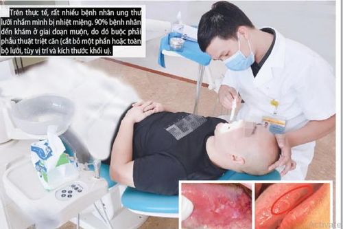 Phân biệt nhiệt miệng và ung thư lưỡi