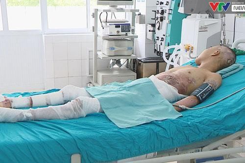 Cầm thanh kim loại gần đường điện cao thế, nam thanh niên bỏng nặng, tổn thương nặng