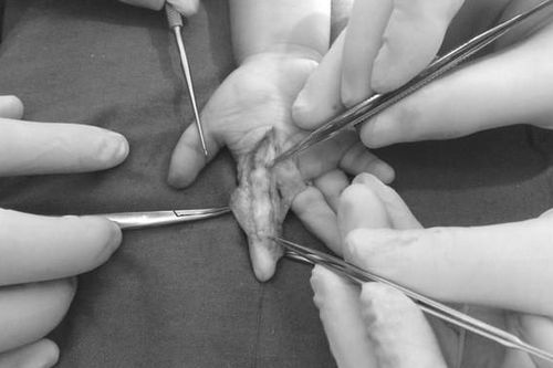 Bé 1 tuổi nắm phải sâu róm, gia đình đắp thuốc Nam khiến trẻ suýt phải cắt bỏ ngón tay
