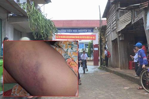 Đề xuất kỷ luật khiển trách cô giáo đánh học sinh lớp 3 bầm tím đùi