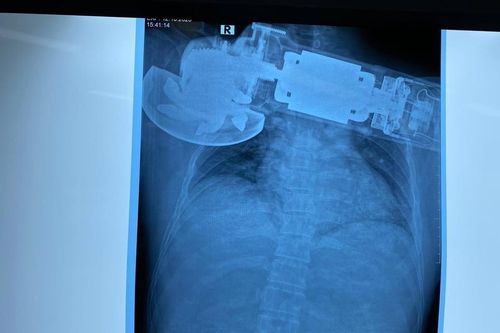 Ngực bầm dập nham nhở vì bị máy chà găm phải trong lúc làm việc