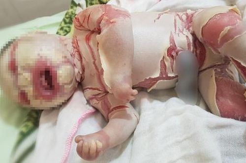 Bé sinh non mắc bệnh da vảy cá với hạ bì dày gấp 10 lần người thường