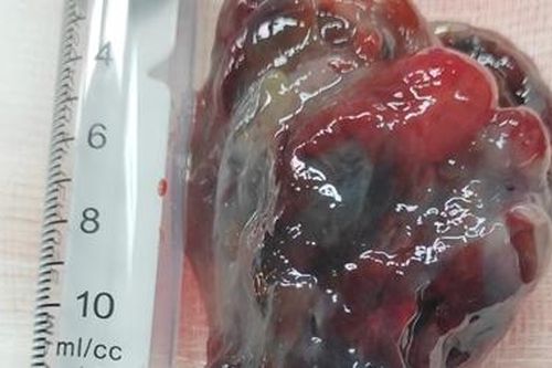 Phẫu thuật xuyên đêm cứu sống bệnh nhân u tim nguy kịch