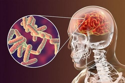 Sốt kéo dài, coi chừng lao màng não