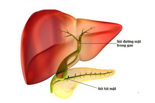 Cảnh giác sỏi đường mật trong gan