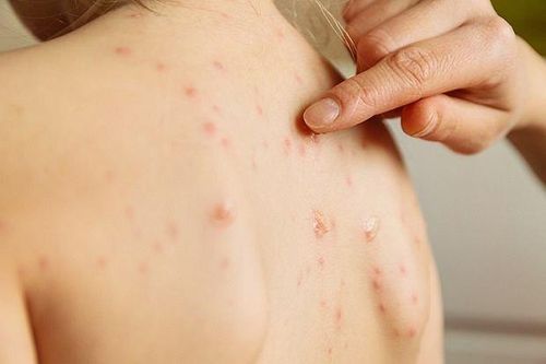 Bệnh nhân HIV bị lở loét toàn thân