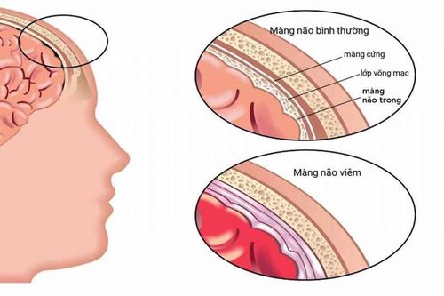 Cấp cứu thành công bé trai 11 tuổi mắc viêm màng não mủ