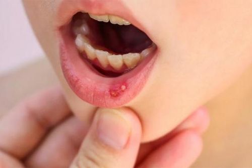 Viêm loét miệng, dùng thuốc gì cho mau lành?