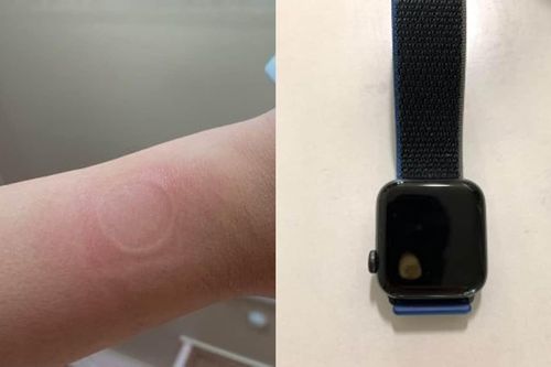 Apple Watch quá nhiệt gây bỏng tay người dùng