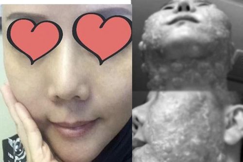 Người phụ nữ bị bỏng rộp cả khuôn mặt khi thực hiện công nghệ trẻ hóa căng da