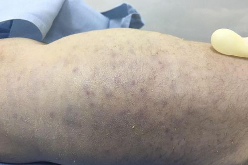 Trẻ sơ sinh tử vong do mẹ nhiễm virus CMV