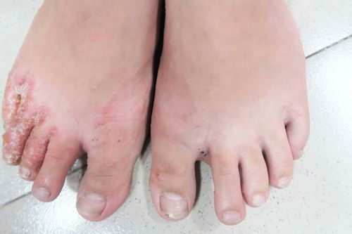 Tiếp xúc với nước lũ bẩn lâu ngày, người dân có thể mắc 4 nhóm bệnh nguy hiểm về da