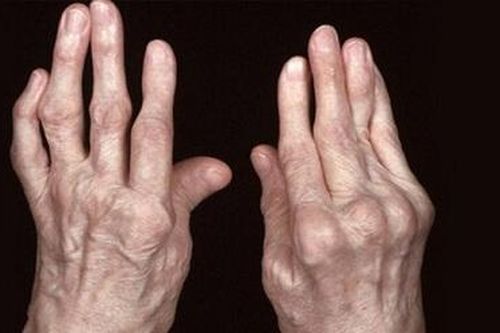 Liệu pháp mới cho người viêm khớp dạng thấp khó trị