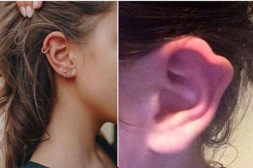 Bị nhiễm trùng khi bấm lỗ tai, nữ sinh phải phẫu thuật lấy khuyên ra và bị biến dạng tai