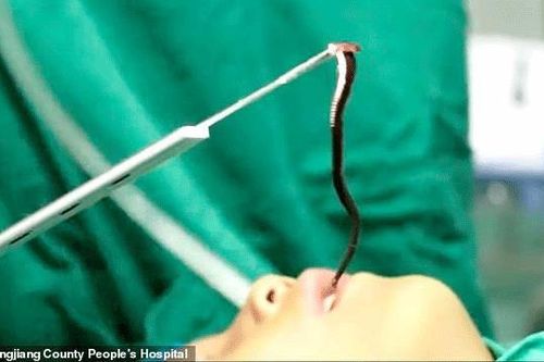 Các bác sỹ phát hiện một con đỉa khổng lồ sống trong đầu đứa trẻ