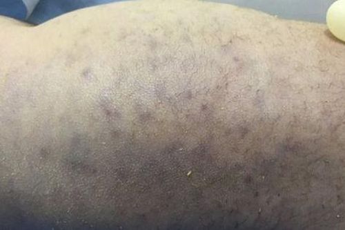 Mẹ nhiễm virus CMV, con vừa sinh ra đã tử vong