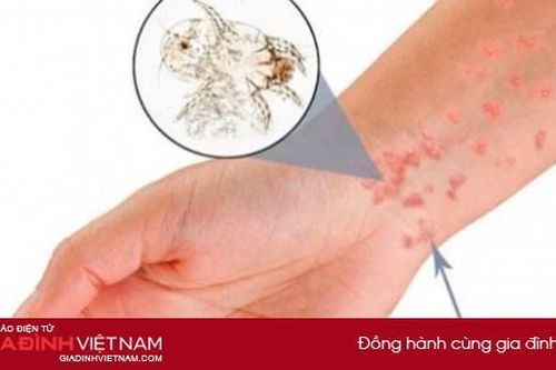 4 cách điều trị ghẻ nước tại nhà bằng mẹo dân gian hiệu quả