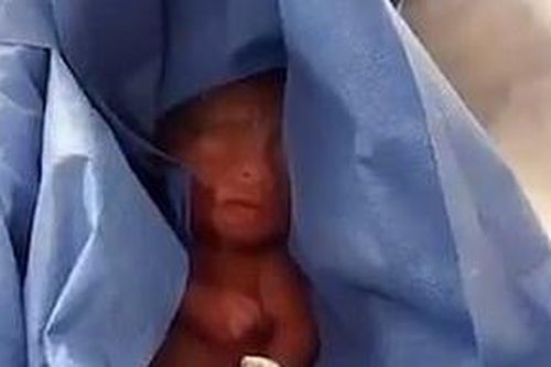 Bị tưởng lầm đã chết, em bé sinh non phải nằm trong tủ đông nhà xác suốt 6 giờ