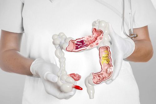 Ngăn chặn nguy cơ ung thư từ bệnh tiêu hóa