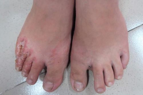 4 bệnh da liễu người dân tại vùng lũ cần cẩn trọng