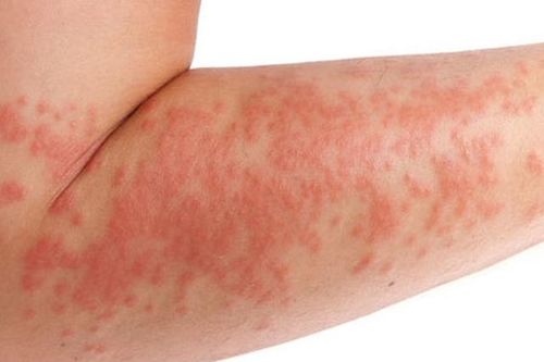 Những căn bệnh ngoài da không ai có thể tránh khỏi