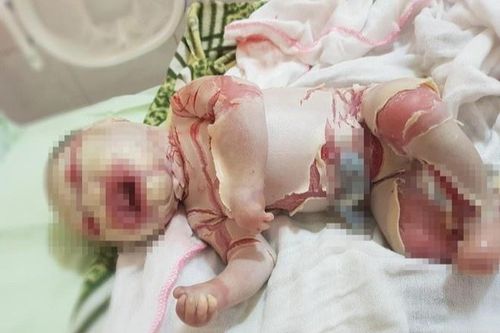 Bé sơ sinh có lớp sừng bao phủ khắp người được xuất viện