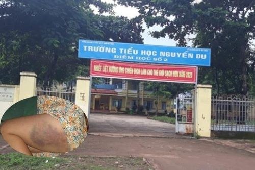 Cô giáo đánh tím đùi học sinh lớp 3 bị phạt gần 4 triệu đồng